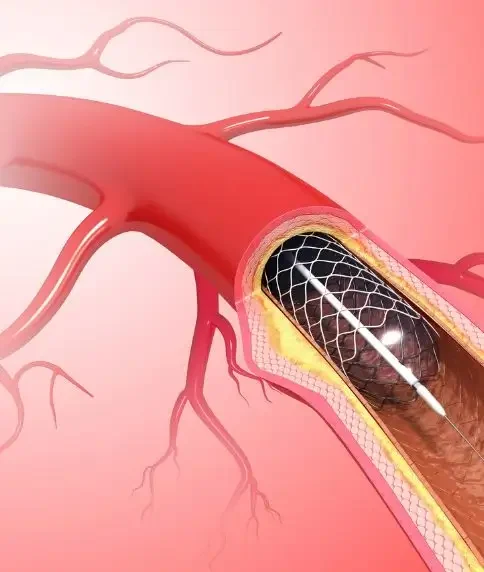 Advanced Angioplasty in Pune by Top Cardiologist – Dr Gajanan Khadkikar Advanced Angioplasty in Pune by Top Cardiologist - Dr Gajanan Khadkikar