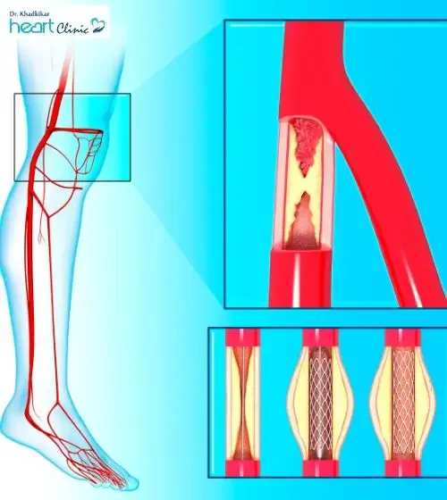 What is Angioplasty – Explained by Top Cardiologist in Moshi – Dr. Gajanan Khadkikar What is Angioplasty - Explained by Top Cardiologist in Moshi - Dr. Gajanan Khadkikar