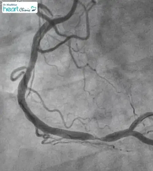 What is coronary angiography in Pune – Explained by Dr Gajanan Khadkikar, Moshi What is coronary angiography in Pune - Explained by Dr Gajanan Khadkikar, Moshi
